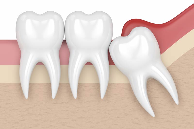 Wisdom Tooth Removal in Fremont